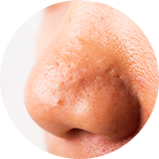 피지